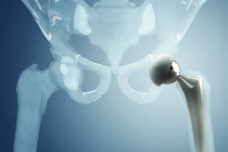 hip-replacement-img
