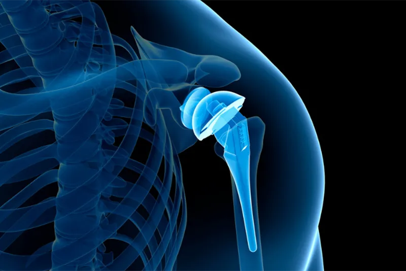 shoulder-replacement-img