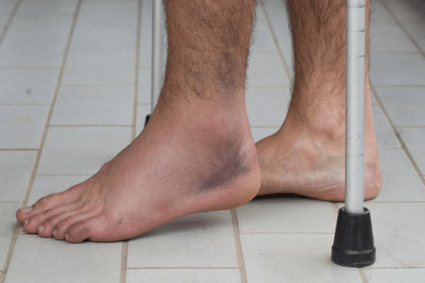 Sprains and Strains Treatment